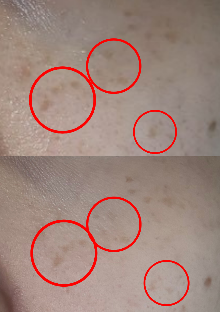 肌質改善 症例写真 6